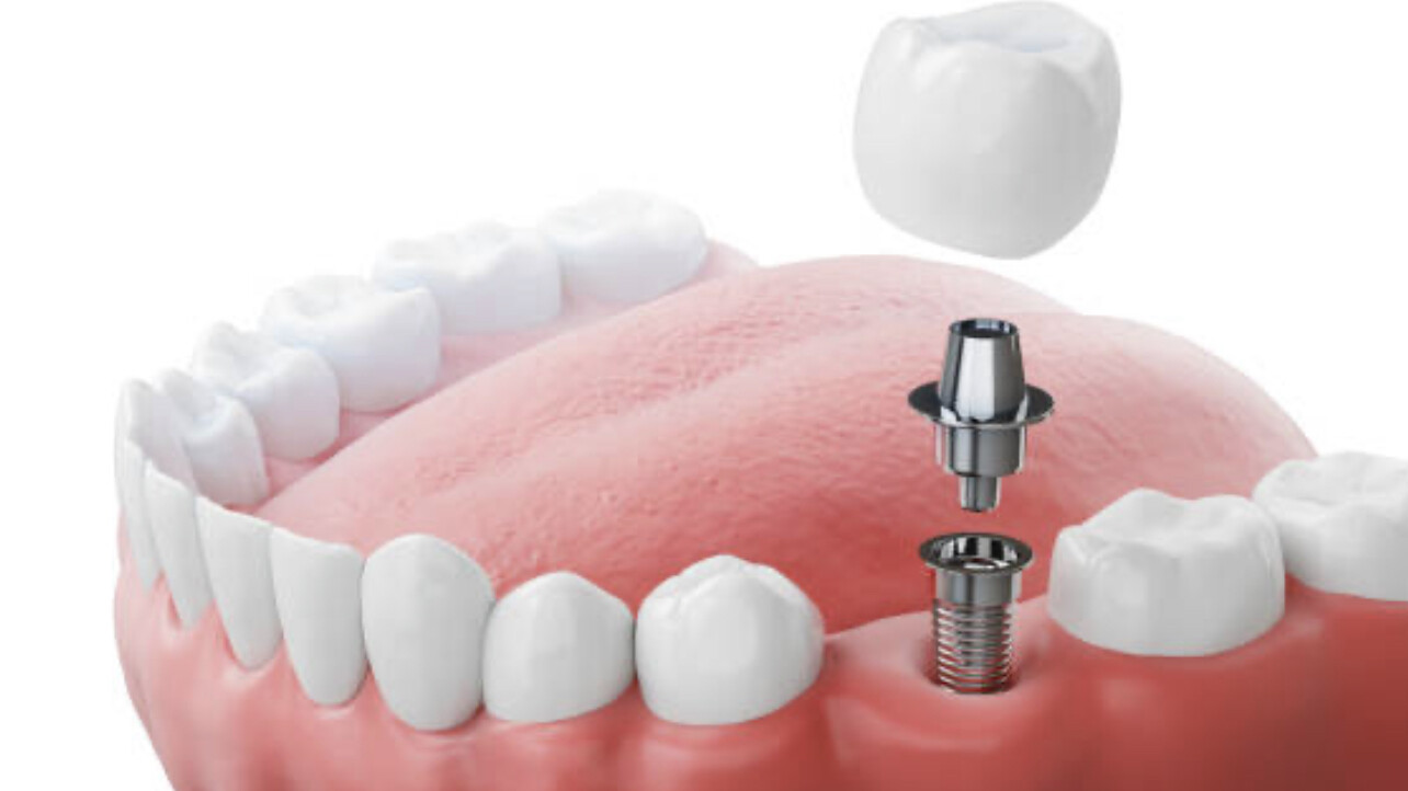 implantologia orale dottor fossali concesio brescia